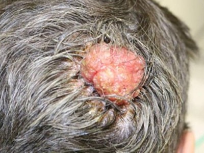 Blumenkohlartiger Knoten am Hinterkopf