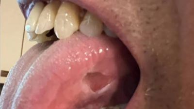 Tongue ulcer, before and after treatment, in patient with giant cell arteritis