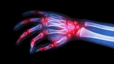 X-ray of hand with arthritis at multiple joints