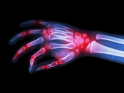 X-ray of hand with arthritis at multiple joints