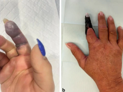 Sepsis des Zeigefingers nach Gartenarbeit