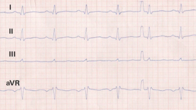 Extremitäten-EKG-Ableitungen bei Aortendissektion