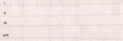 Extremitäten-EKG-Ableitungen bei Aortendissektion