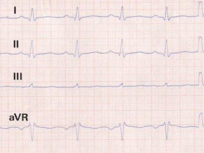 Extremitäten-EKG-Ableitungen bei Aortendissektion