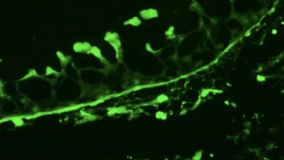 Image from case study_Direct immunofluorescence of the conjunctival biopsy in a patient with ocular mucous membrane pemphigoid, displaying linear deposits of IgG, IgM, and C3