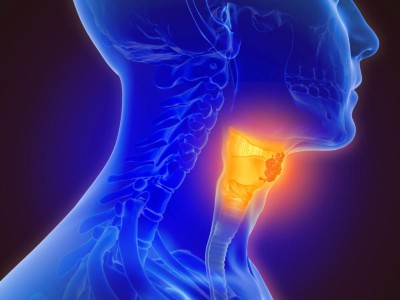 3D illustration of throat cancer