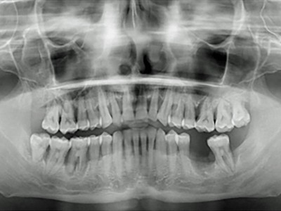 Orthopantomogramm. Zahn 46 wurde im Behandlungsverlauf entfernt. Parodontitis Stadium IV Grad C sichtbar