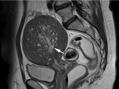 Ausgeprägte Adenomyose