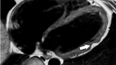 Kardio-MRT bei arrhythmogener Kardiomyopathie
