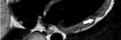 Kardio-MRT bei arrhythmogener Kardiomyopathie