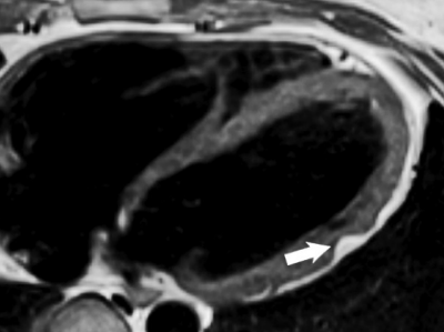Kardio-MRT bei arrhythmogener Kardiomyopathie