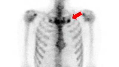 Scans of patient with Takayasu arteritis and SAPHO syndrome