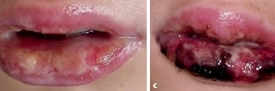 Blutige Mukositis Tag 9 nach stationärer Aufnahme