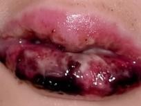 Blutige Mukositis Tag 9 nach stationärer Aufnahme