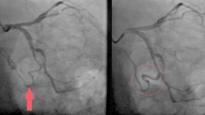 Coronary angiography demonstrating an ectatic vessel arising from the left circumflex artery supplying a lung mass
