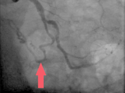 Coronary angiography demonstrating an ectatic vessel arising from the left circumflex artery supplying a lung mass