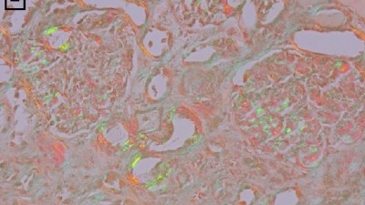 Immunohistochemistry of patient with kidney involvement in VEXAS syndrome