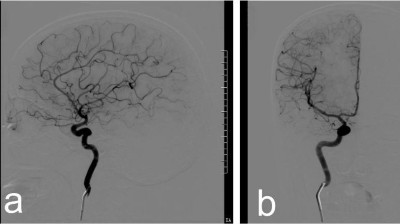 Image from case study_Thrombolysis within the right central retinal artery guided by cerebral angiography in a diabetic patient with retinal artery occlusion