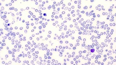 Histologie einer β-Thalassaemia major