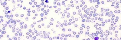 Histologie einer β-Thalassaemia major