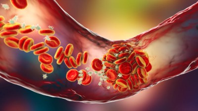 Illustration showing thrombus in a blood vessel