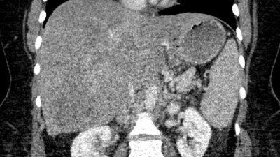 CT des Abdomens bei Aszites