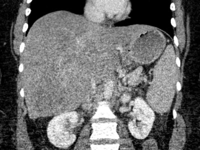 CT des Abdomens bei Aszites