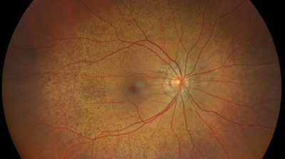 Leitthema: Pseudoxanthoma elasticum (PXE) – Diagnose durch Blick ins Auge - Titelbild