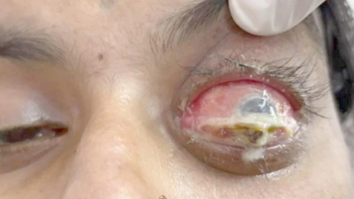 Axial proptosis and congestion of the left eye, with a perforated corneal ulcer 