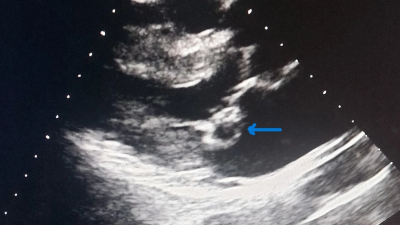 Echocardiography of a 50-year-old female showing blood cyst at posterior mitral leaflet apex and associated atrial septal aneurysm; blue arrow indicates a cyst located at the tip of the posterior mitral leaflet