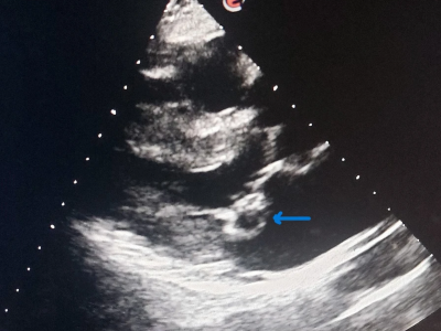 Echocardiography of a 50-year-old female showing blood cyst at posterior mitral leaflet apex and associated atrial septal aneurysm; blue arrow indicates a cyst located at the tip of the posterior mitral leaflet