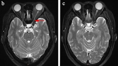 Image from case study_MRI scan of the optic nerve in a patient with optic neuritis associated with Sjögren’s syndrome