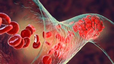 Podcast mit Partnern - Novartis Pharma GmbH: Polycythaemia vera