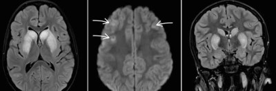 Akutes Parkinsonsyndrom bei Encephalitis durch Mykoplasmen bei 10-Jährigem