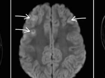 Akutes Parkinsonsyndrom bei Encephalitis durch Mykoplasmen bei 10-Jährigem