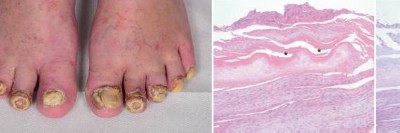 Nagelpsoriasis