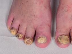 Nagelpsoriasis