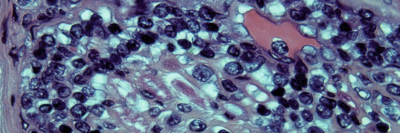 Histologie bei Multiplex-Neuropathie