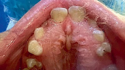 Intraorale Aufnahmen: hochgewölbter Gaumen mit Schleimhautverdickung und kariösen Zähnen
