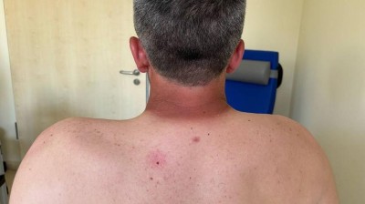 Verminderte Schulterhebung beim Patient