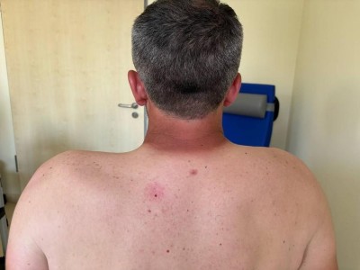 Verminderte Schulterhebung beim Patient