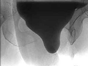 Miktionszysturethrogramm bei Dauerkatheterversorgung nach Harnverhalt im Rahmen einer hochgradigen Zystozele