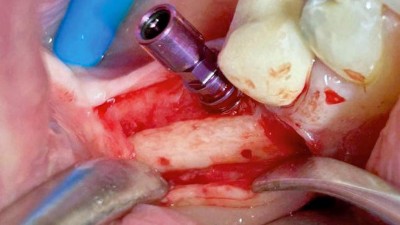  Inseriertes Implantat regio 36 nach Entfernung der Osteosyntheseschrauben. Im Kieferkamm ist ein Knochenblocktransplantat sichtbar