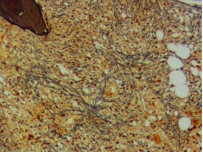 Knochenmarkbiopsy zeigt eine multiple fokale Fibrose