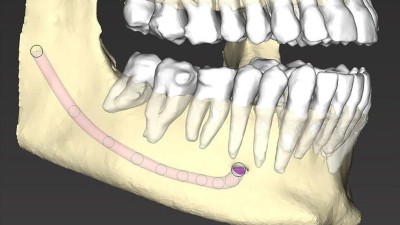 Markierung des Verlaufs des N. alveolaris inferior in der seitlichen Ansicht der digitalen Darstellung eines Unterkiefers