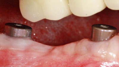 zwei Gingivaformer im Unterkiefer mit ausgeheilter Gingiva