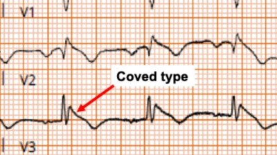 ECG of patient with chronic lymphocytic leukemia and Brugada syndrome