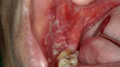Blasenbildende Autoimmundermatose: weißliche Flecken des Pemphigus vulgaris an der Wangeninnenseite