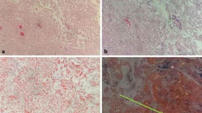 Histologie einer isolierten Harnblasenamyloidose eines 49-Jährigen