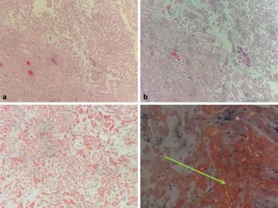 Histologie einer isolierten Harnblasenamyloidose eines 49-Jährigen